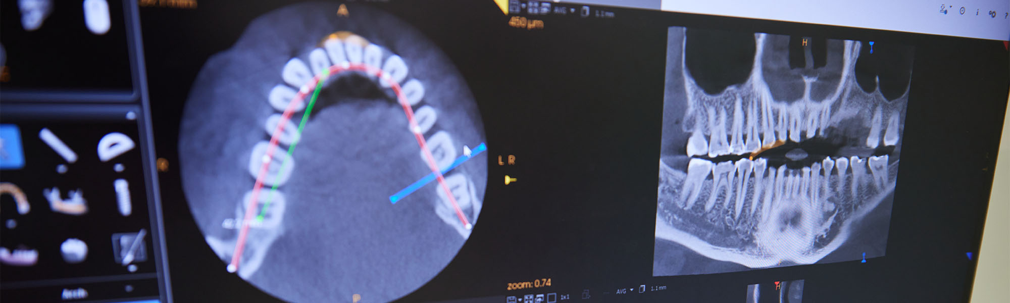 Digital X-rays Cerritos CA