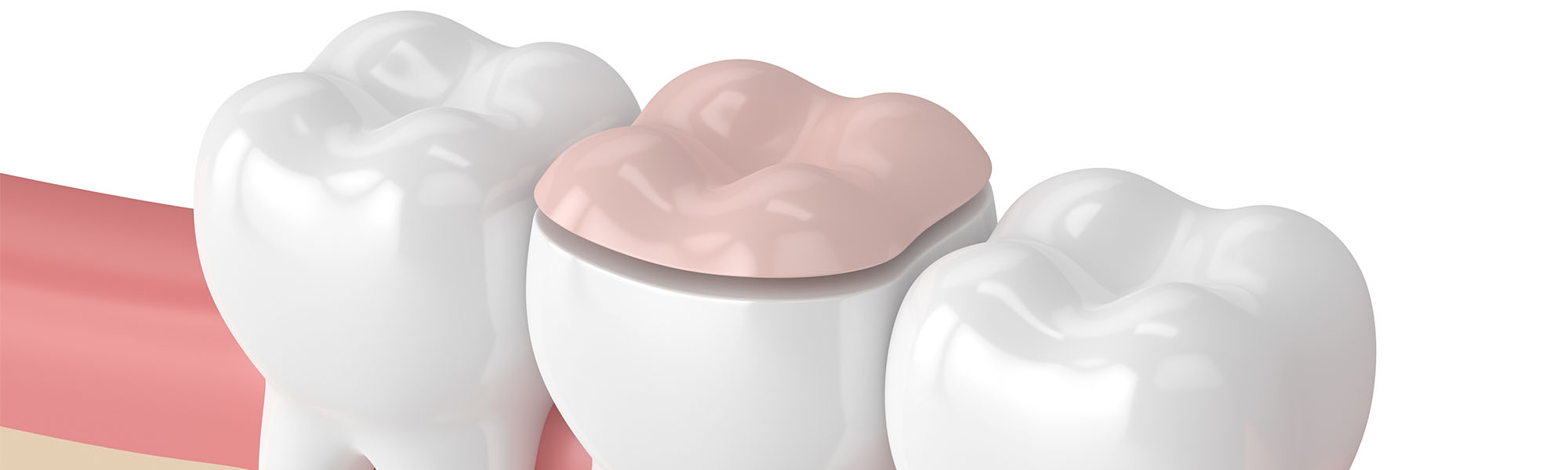 Porcelain Inlays & Onlays Cerritos CA