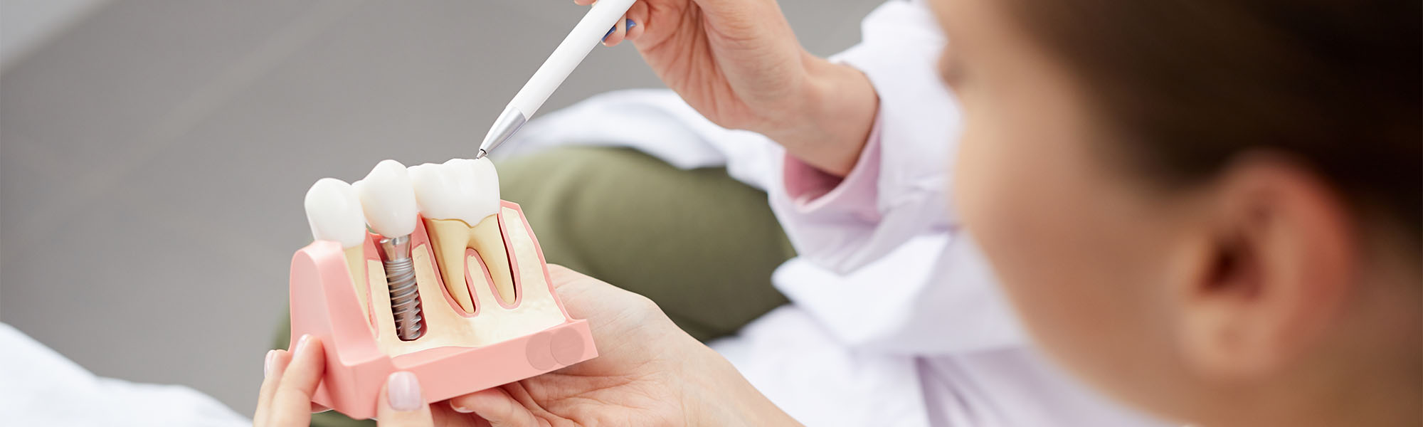 Single Tooth Implants Cerritos CA