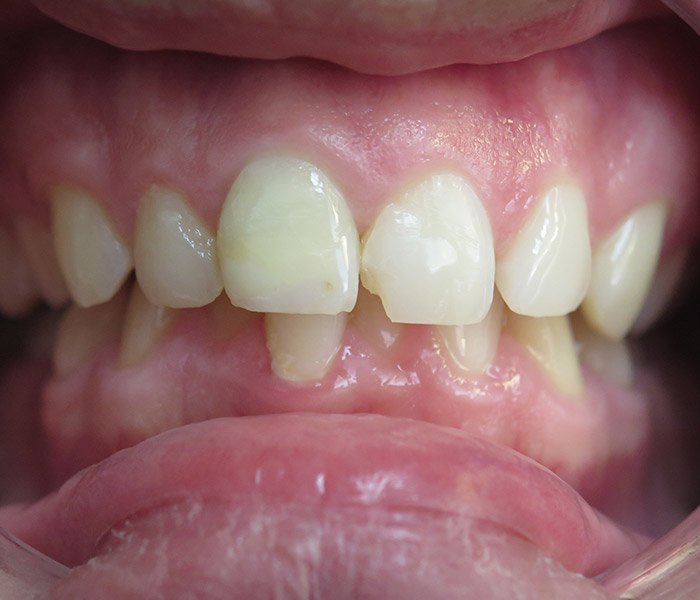 Composite Fillings Before