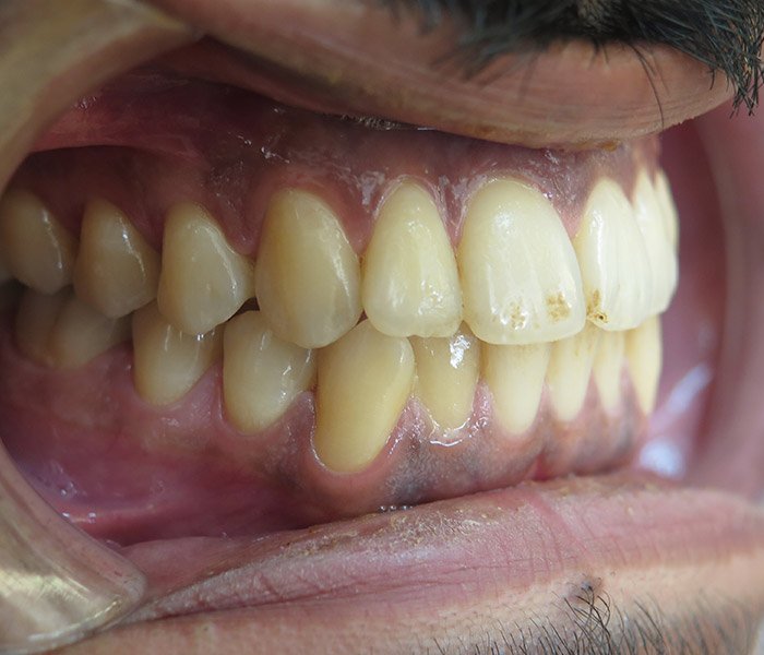 Teeth Cleaning Before