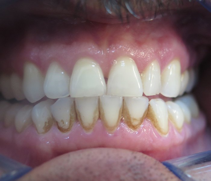 Teeth Cleaning Before