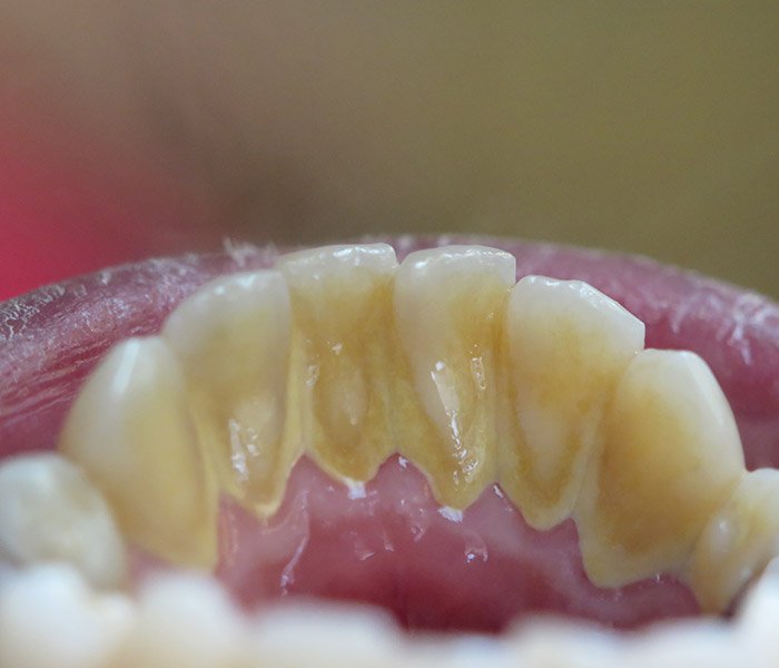 Teeth Cleaning Before