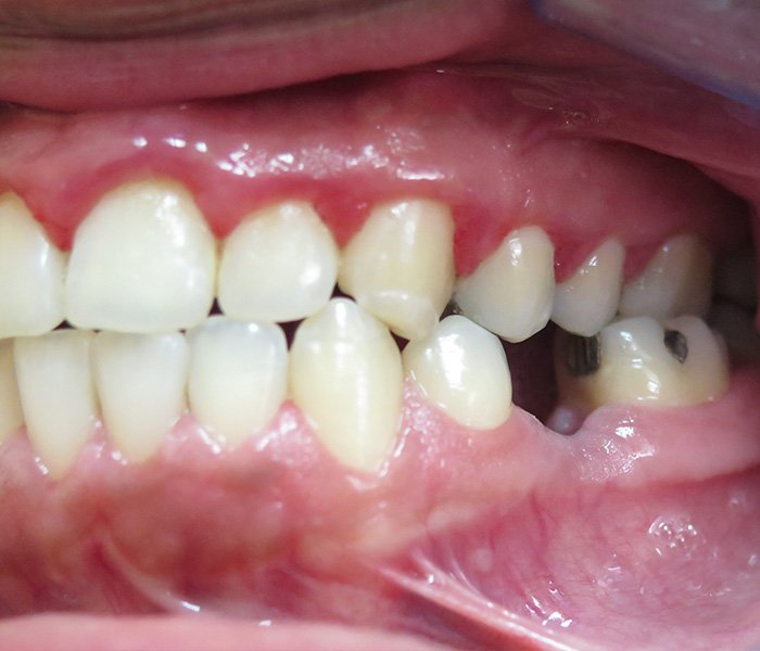 Dental Implants Before