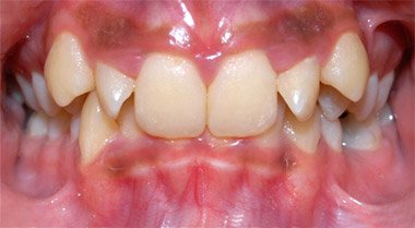 Orthodontics Before
