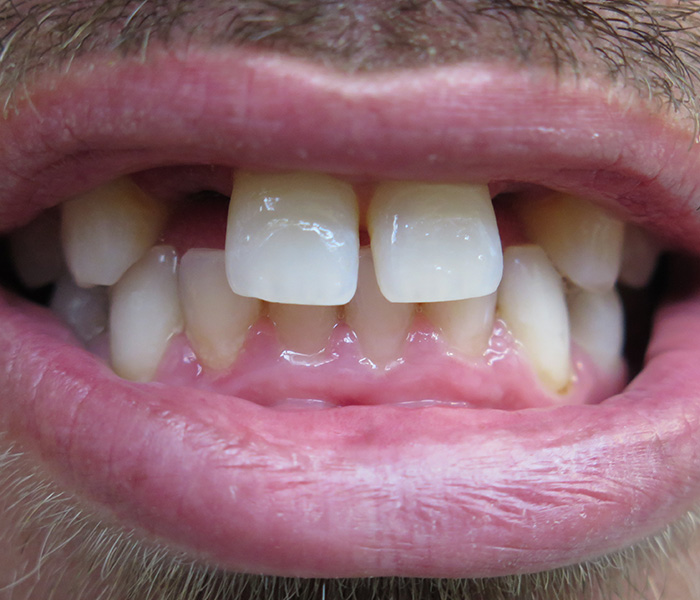 Dental Implants Before