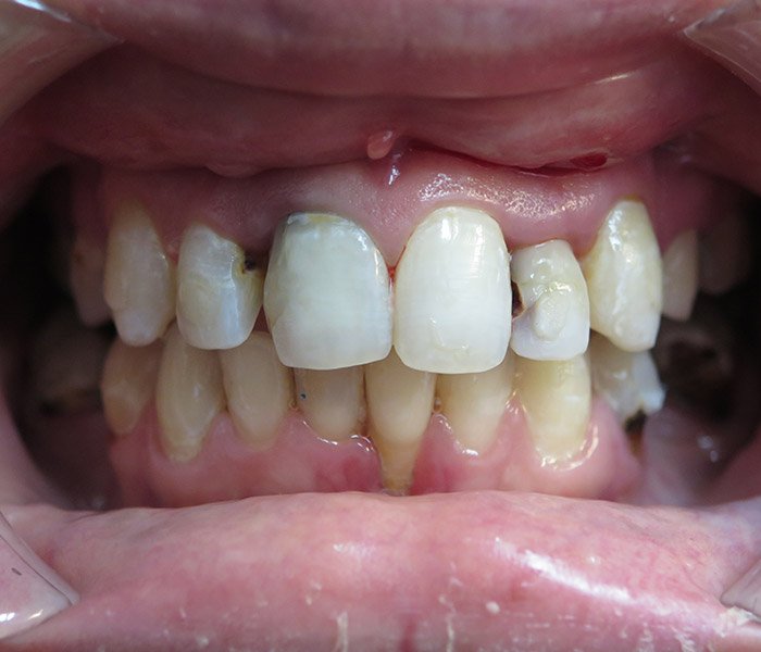 Dental Implants Before