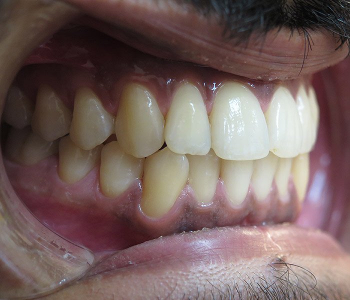 Teeth Cleaning After