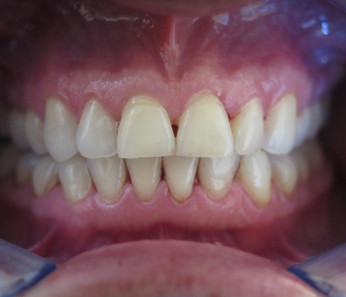 Teeth Cleaning After