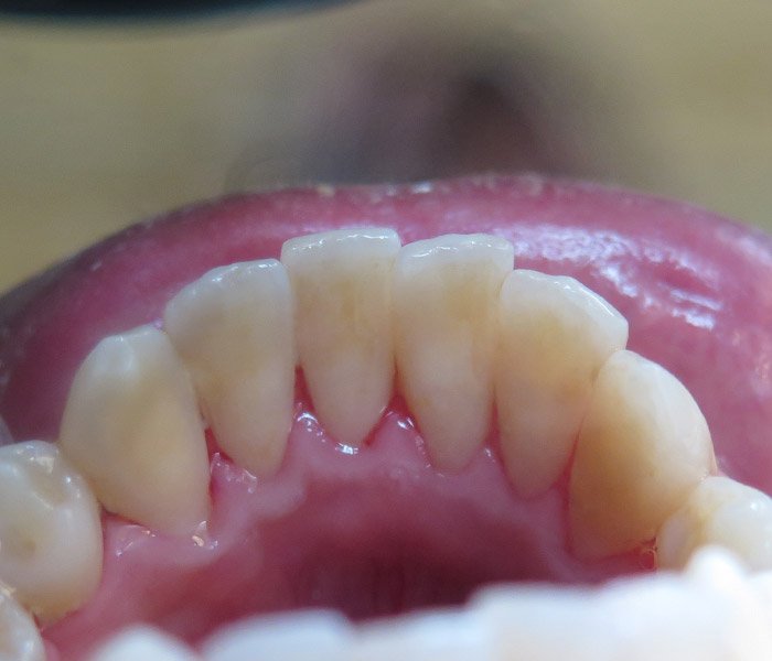 Teeth Cleaning After