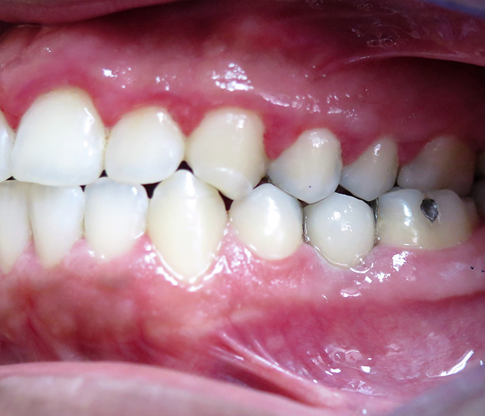 Dental Implants After