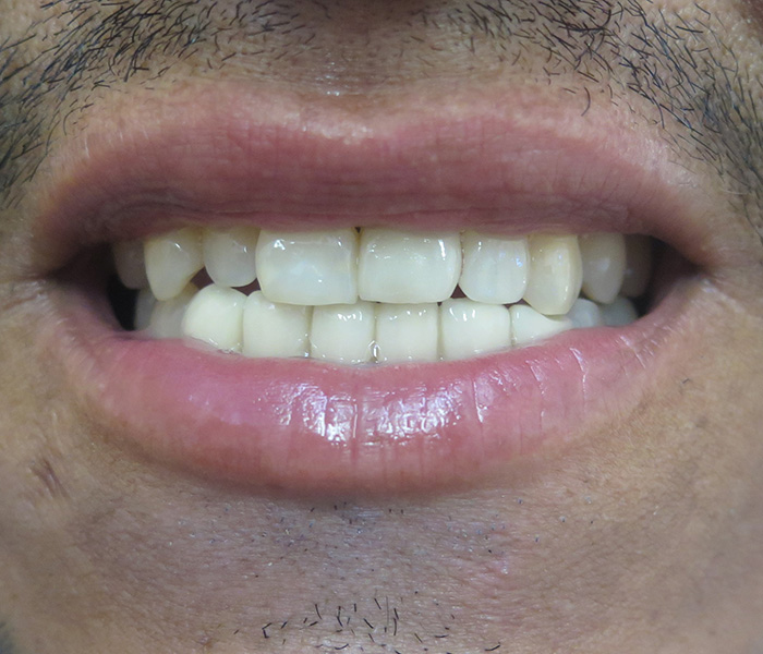Veneers After