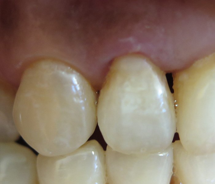 Composite Fillings After
