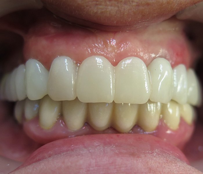 Dental Implants After