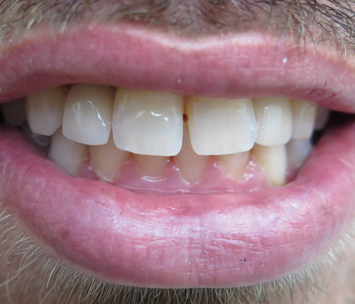 Dental Implants After