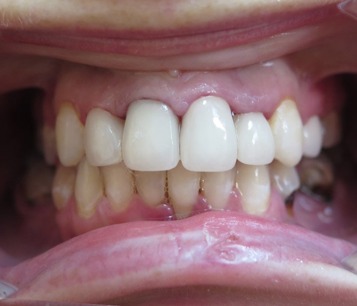 Dental Implants After