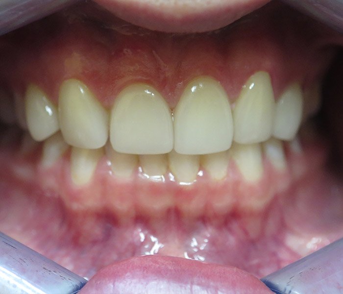 Veneers After
