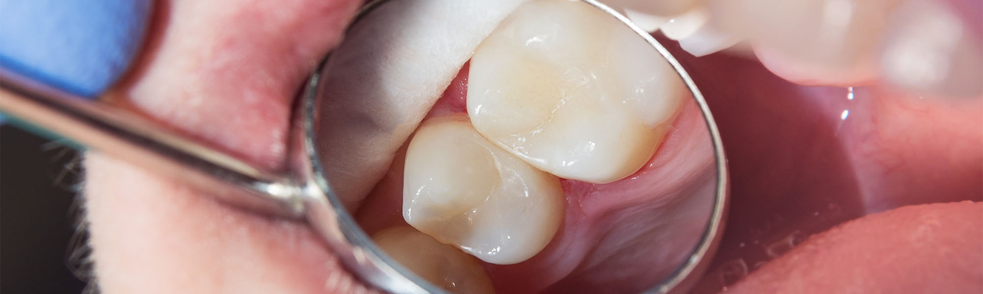 Composite Fillings in Cerritos CA