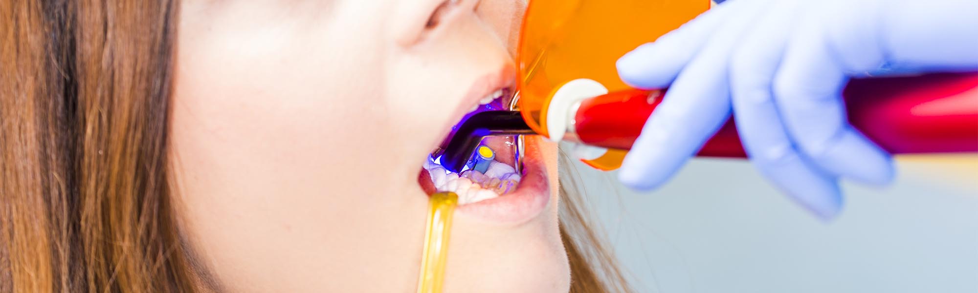 Composite Fillings Dentist in Cerritos CA