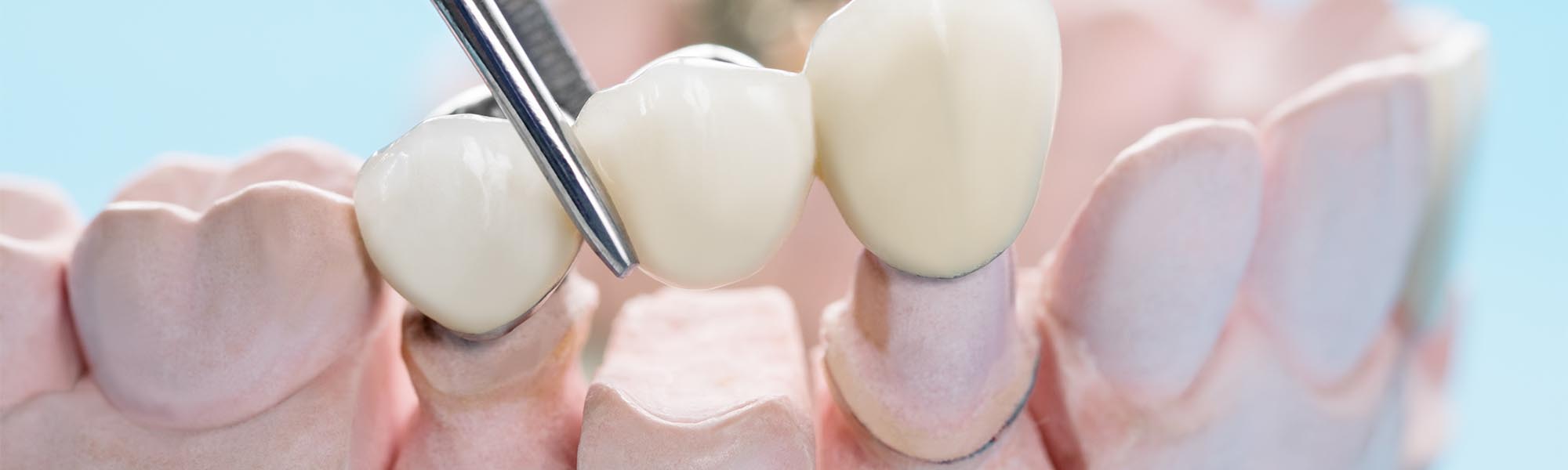 Dental Bridges Dentist in Cerritos CA