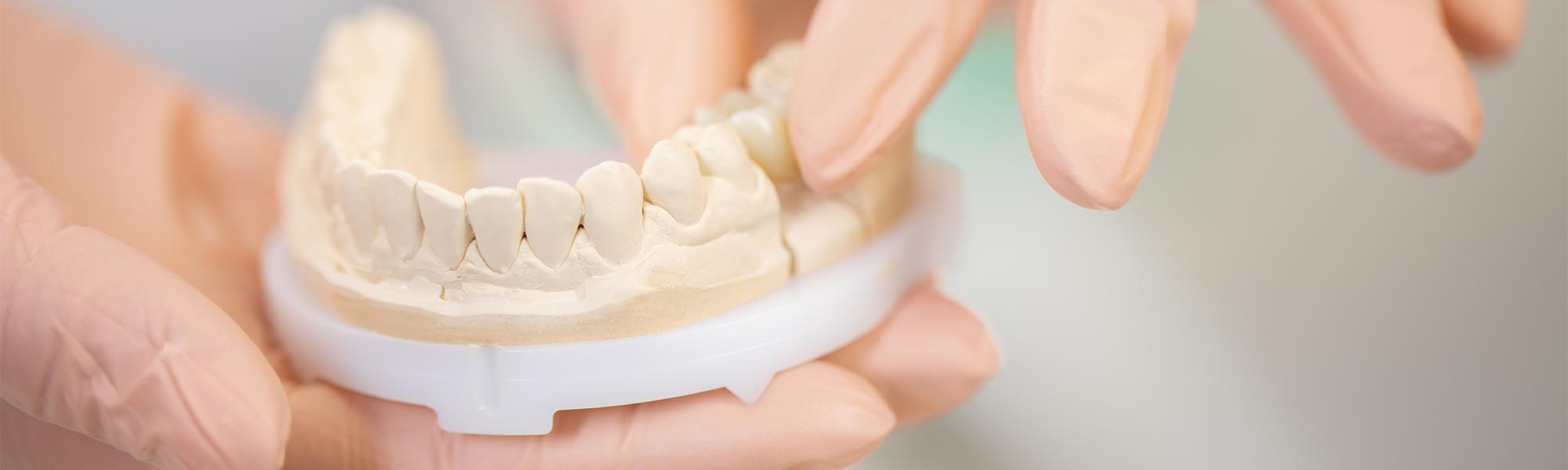 Dental Bridges in Cerritos CA