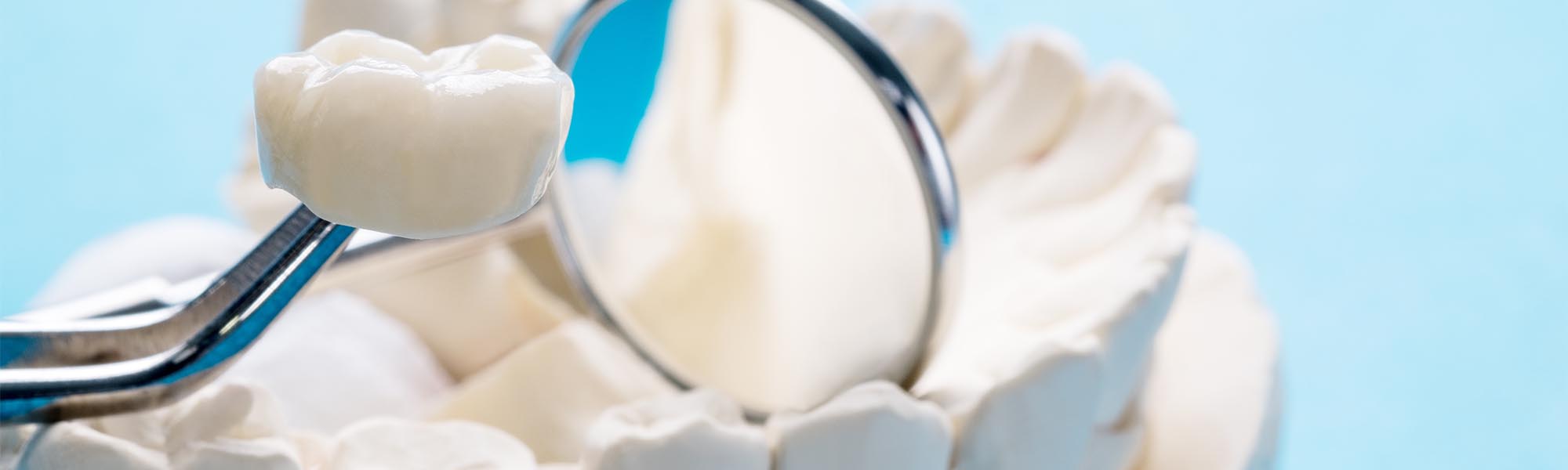 Dental Bridges Procedure in Cerritos CA