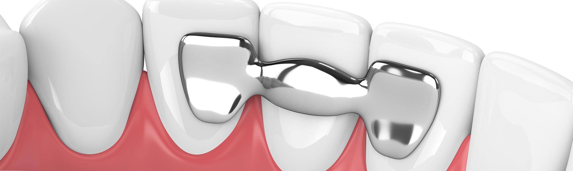 Dental Bridges Type in Cerritos CA