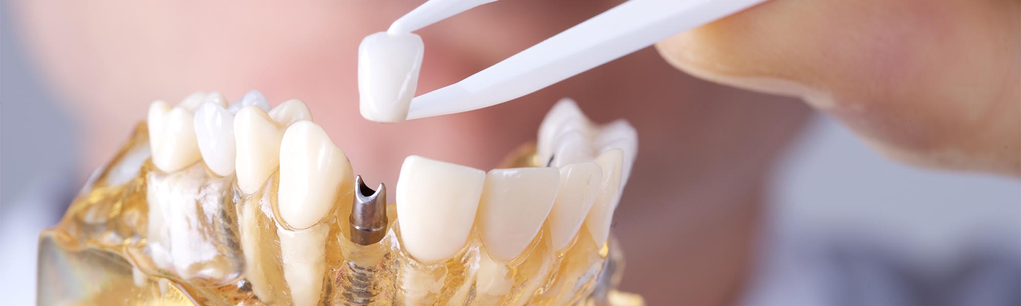 Dental Implants Dentistry in Cerritos CA