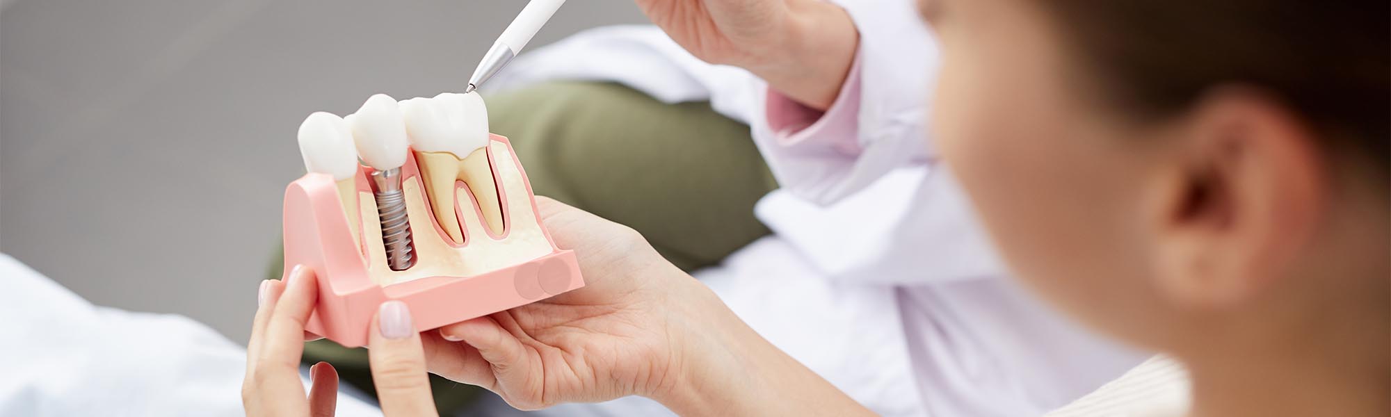 Dental Implants in Cerritos CA