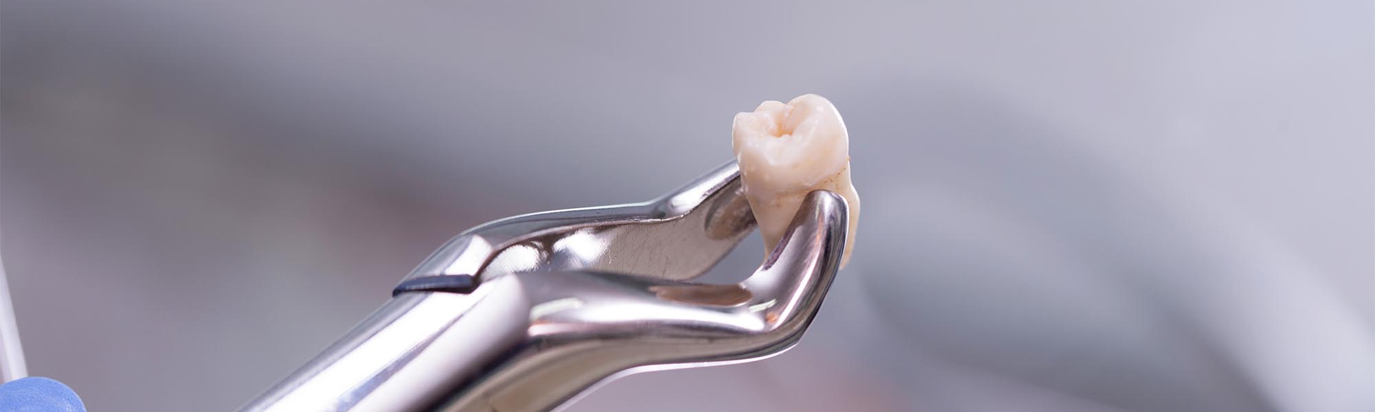 Wisdom Tooth Extraction Cerritos CA