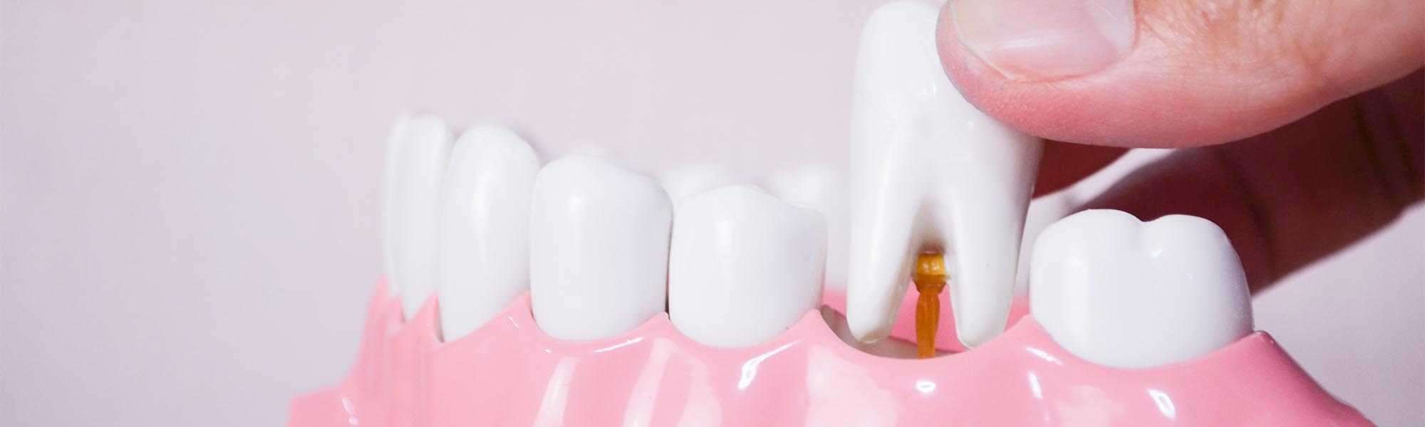 Tooth Extractions Cerritos CA