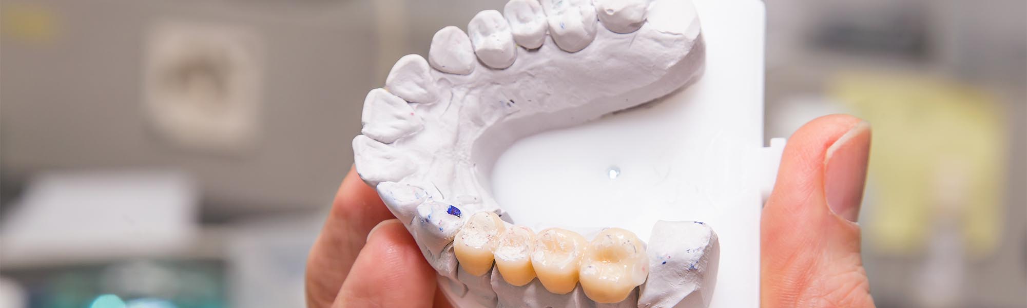 Porcelain Fixed Bridges Cerritos CA