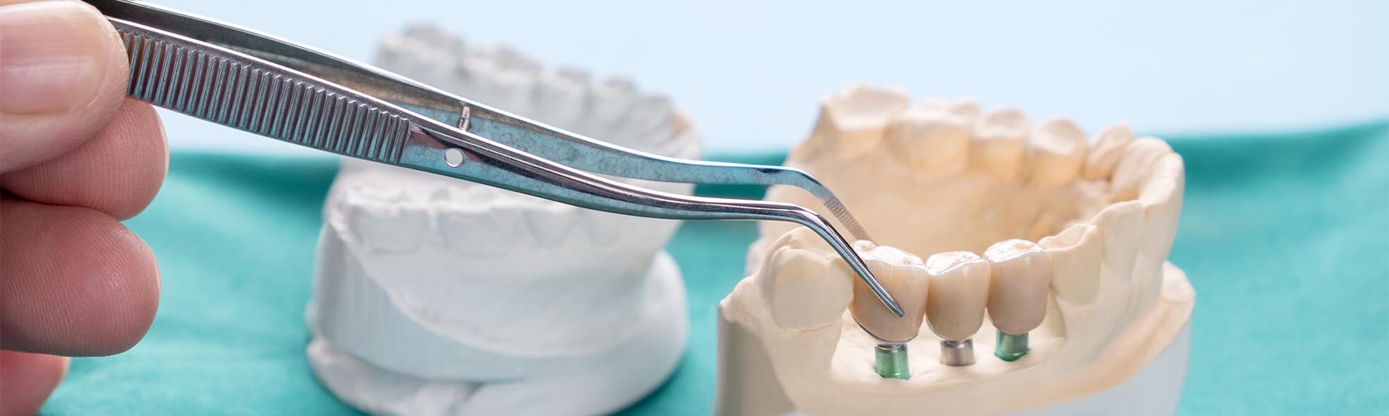 Porcelain Fixed Bridges in Cerritos CA