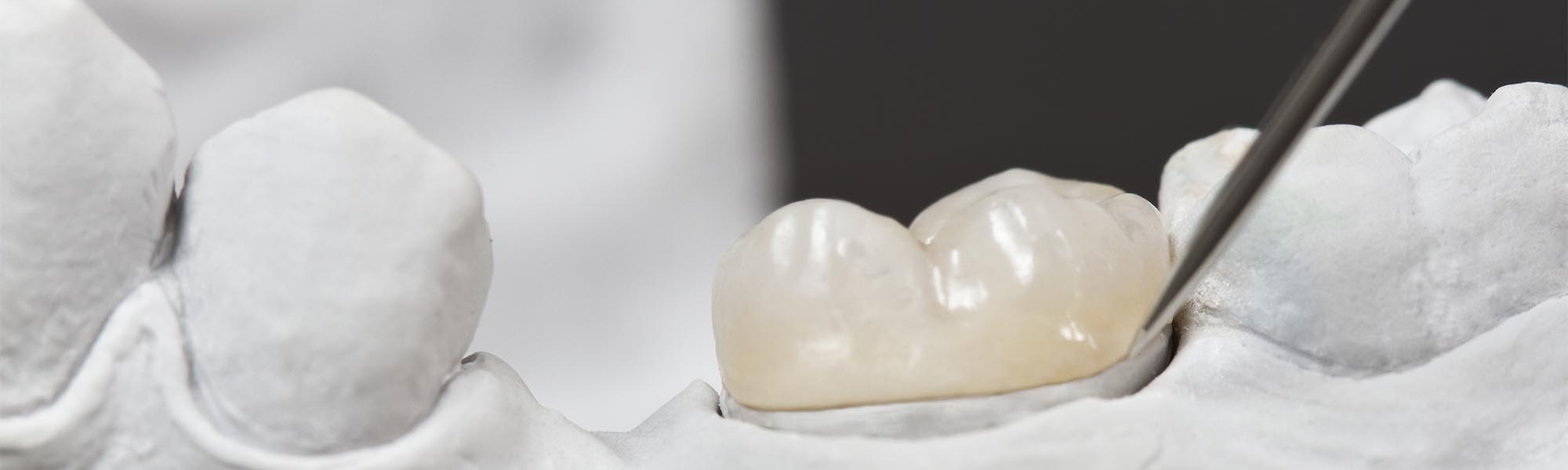 Porcelain Inlays & Onlays Cerritos CA