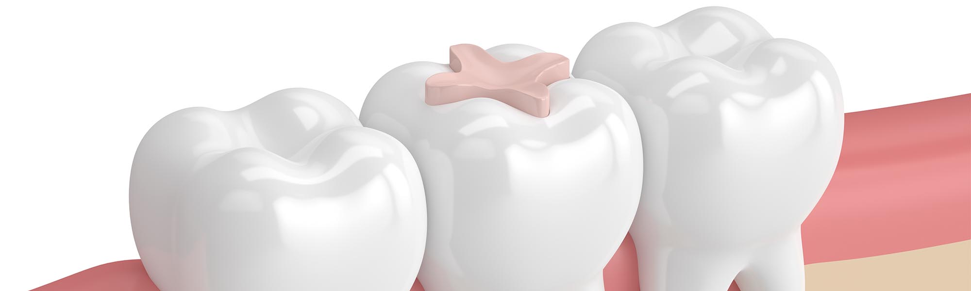 Restorative Inlays & Onlays Cerritos CA