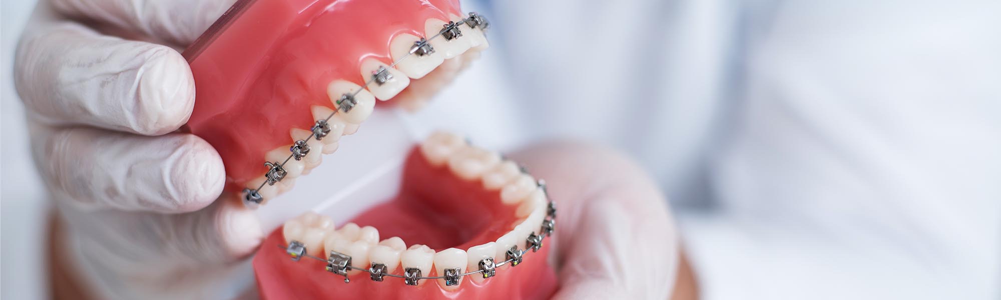 Metal Braces Advantages Cerritos CA