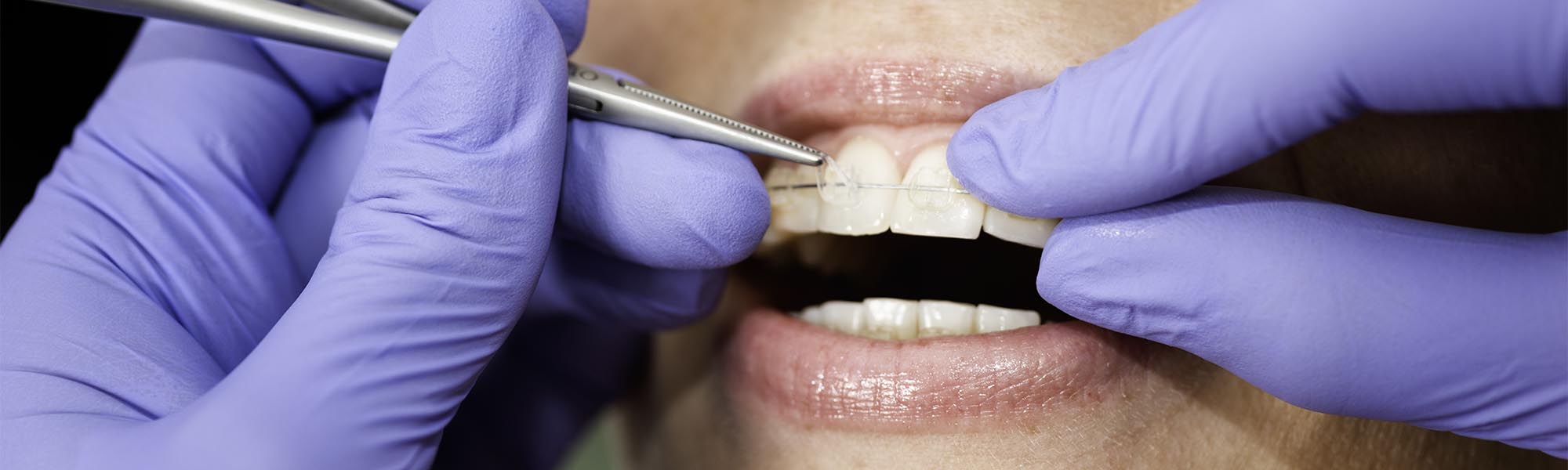 Porcelain Ceramic Braces Cerritos CA