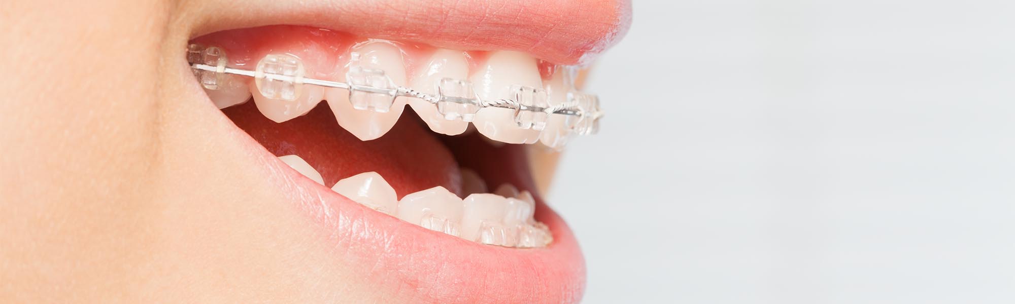 Porcelain Ceramic Braces in Cerritos CA