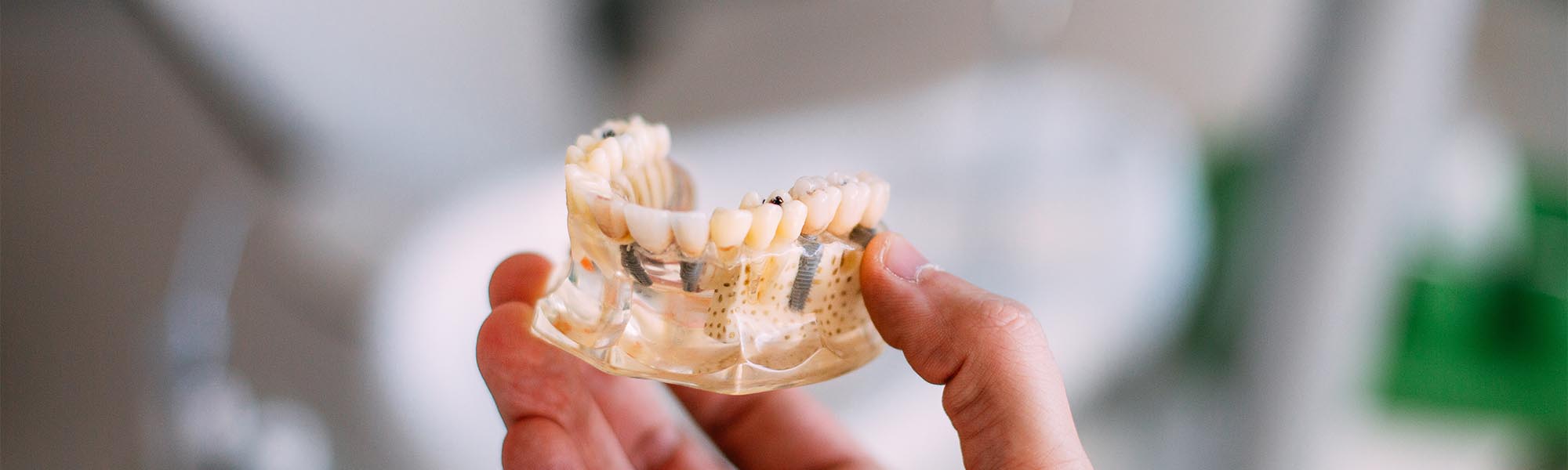 Multiple Teeth Implants Cerritos CA