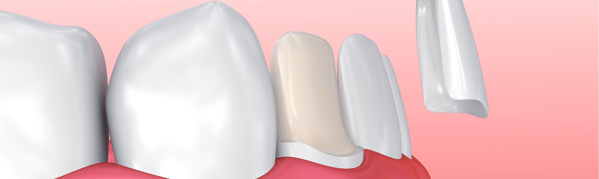 Porcelain Veneers Benefits Cerritos CA