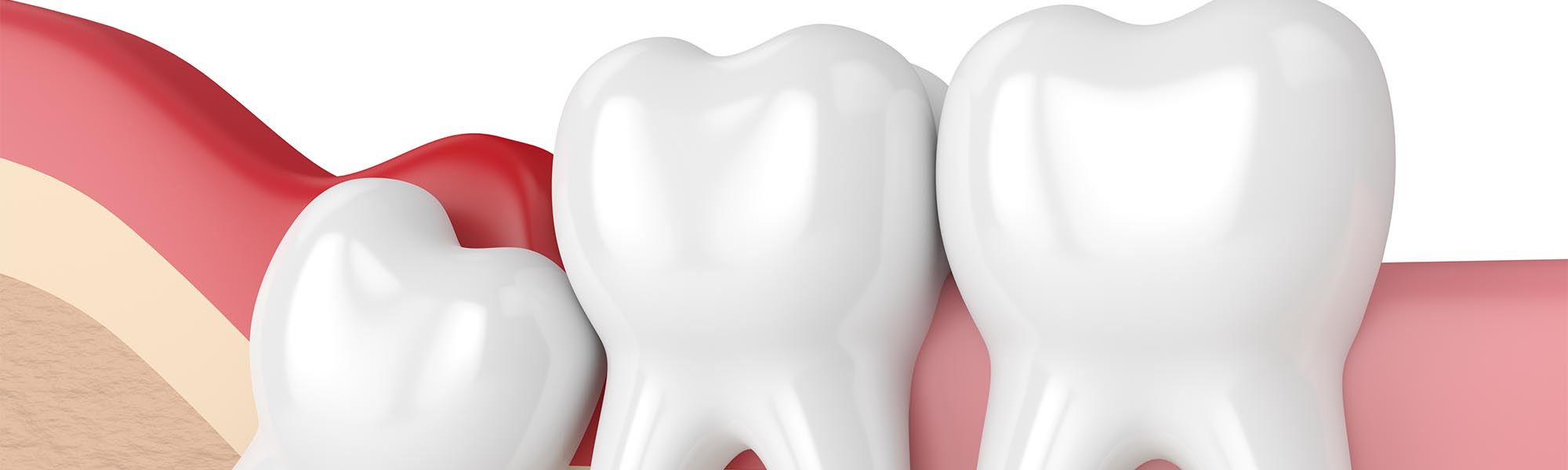 Wisdom Teeth Removal in Cerritos CA